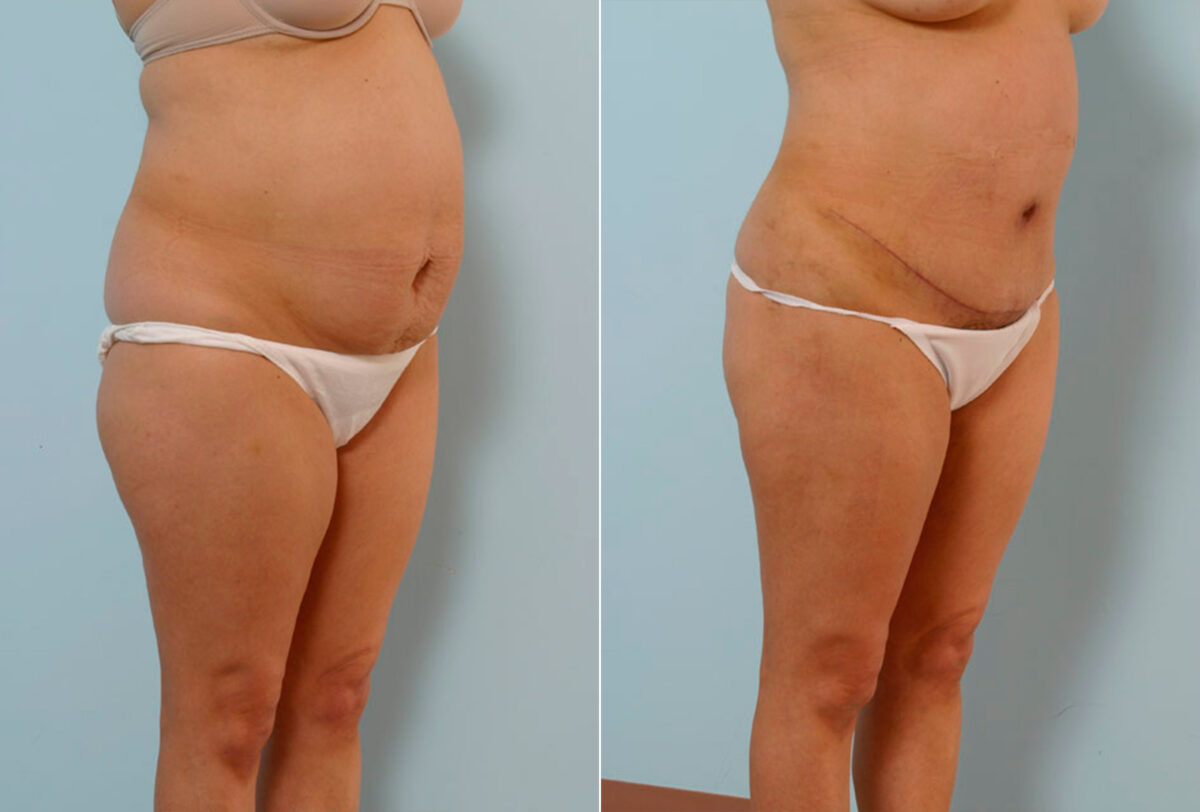 Abdominoplasty before and after photos in Houston, TX, Patient 24367