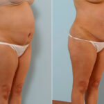 Abdominoplasty before and after photos in Houston, TX, Patient 24367