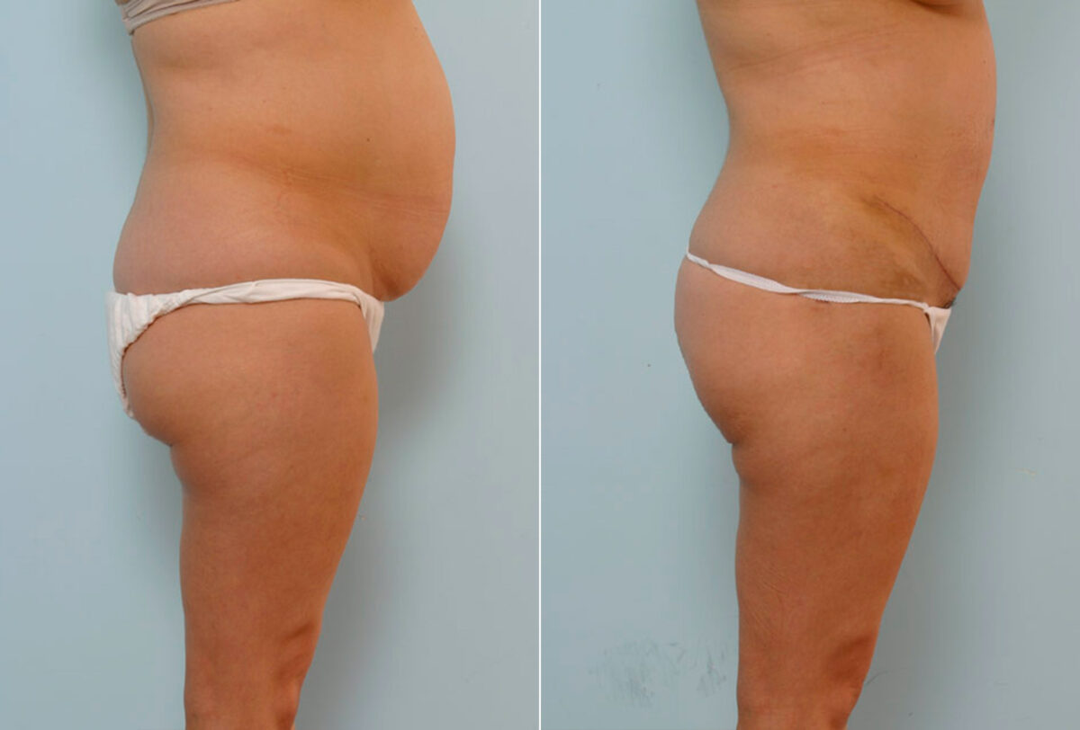 Abdominoplasty before and after photos in Houston, TX, Patient 24367