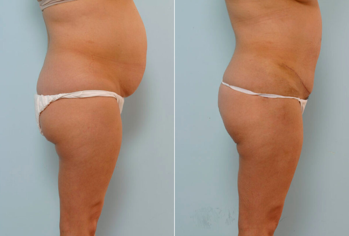Tummy Tuck/Abdominoplasty before and after photos in Houston, TX, Patient 24367