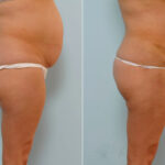 Abdominoplasty before and after photos in Houston, TX, Patient 24367