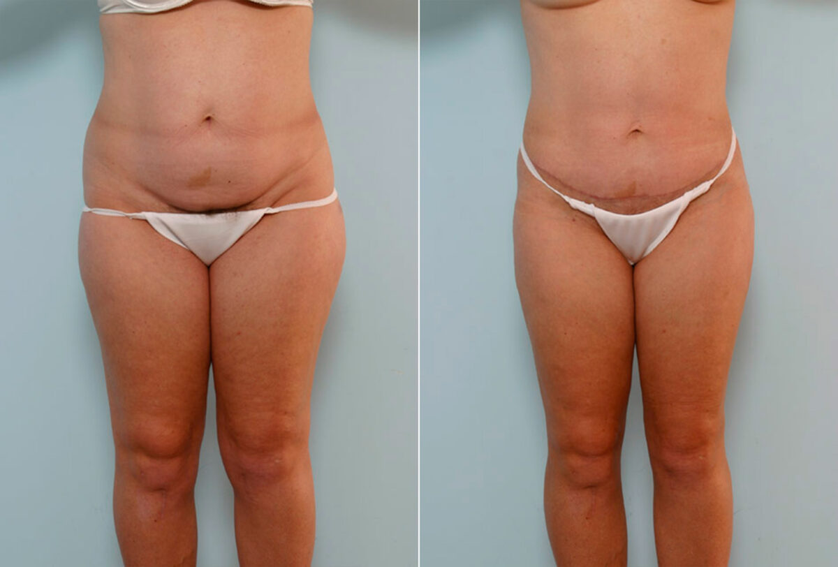 Abdominoplasty before and after photos in Houston, TX, Patient 24374