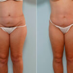 Abdominoplasty before and after photos in Houston, TX, Patient 24374
