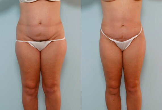 Tummy Tuck/Abdominoplasty before and after photos in Houston, TX, Patient 24374