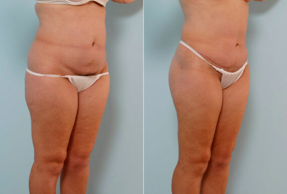 Abdominoplasty before and after photos in Houston, TX, Patient 24374