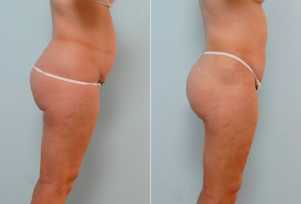 Abdominoplasty before and after photos in Houston, TX, Patient 24374