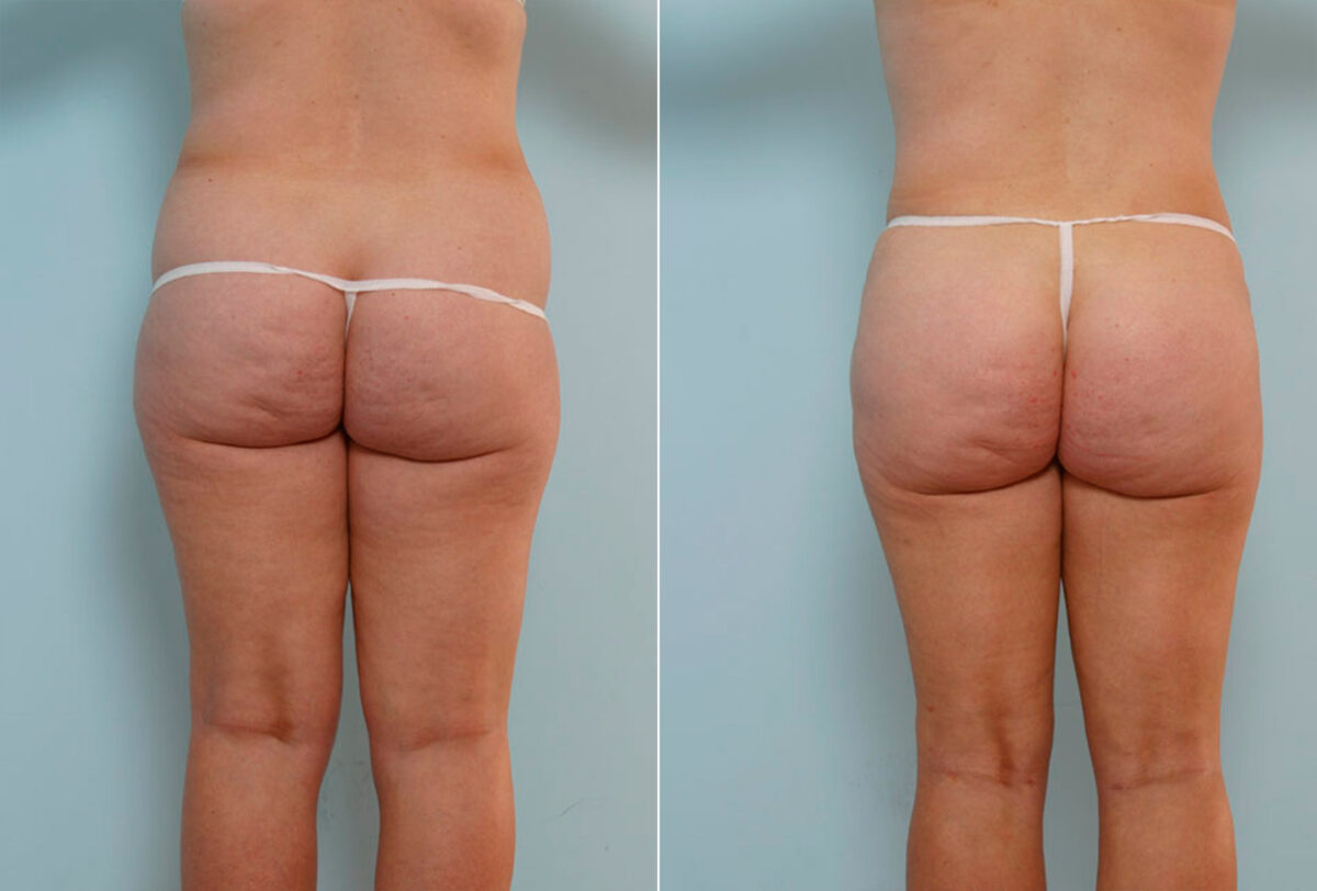 Abdominoplasty before and after photos in Houston, TX, Patient 24374