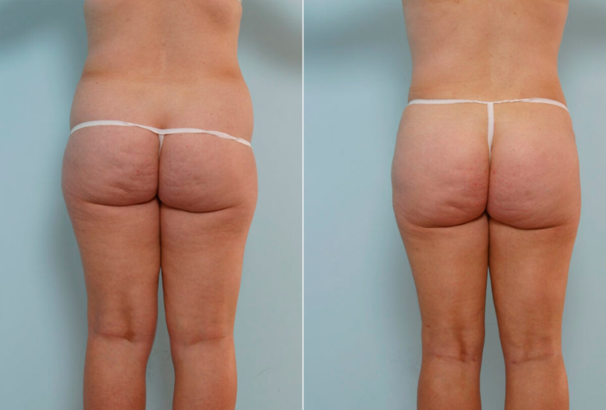 Tummy Tuck/Abdominoplasty before and after photos in Houston, TX, Patient 24374