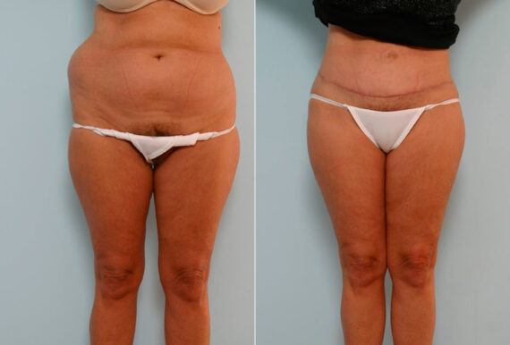 Tummy Tuck/Abdominoplasty before and after photos in Houston, TX, Patient 24392