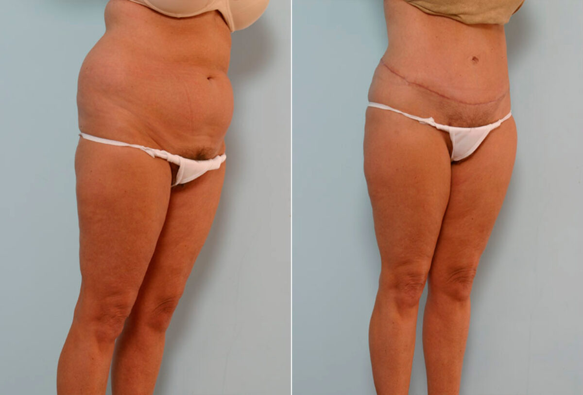 Tummy Tuck/Abdominoplasty before and after photos in Houston, TX, Patient 24392
