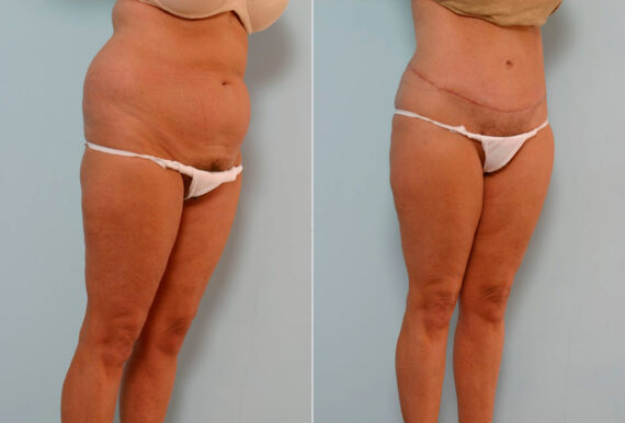 Abdominoplasty before and after photos in Houston, TX, Patient 24392