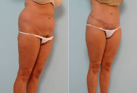 Tummy Tuck/Abdominoplasty before and after photos in Houston, TX, Patient 24392
