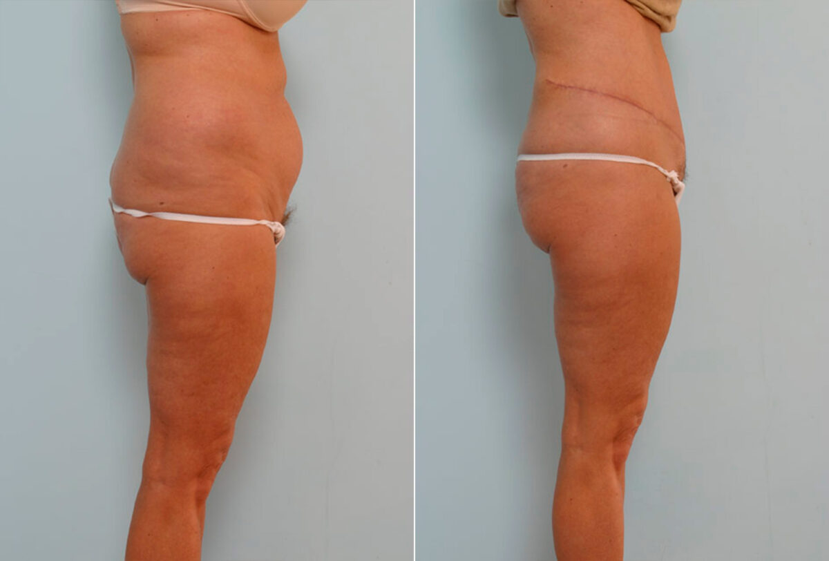 Abdominoplasty before and after photos in Houston, TX, Patient 24392