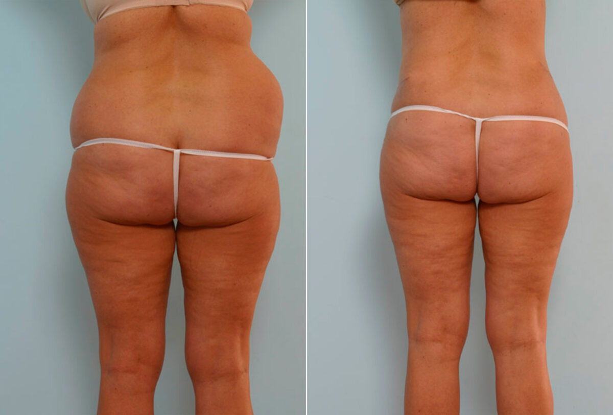 Tummy Tuck/Abdominoplasty before and after photos in Houston, TX, Patient 24392