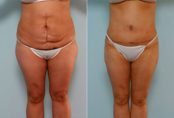 Abdominoplasty before and after photos in Houston, TX, Patient 24401