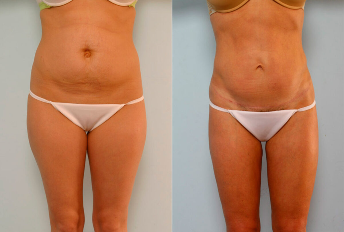 Abdominoplasty before and after photos in Houston, TX, Patient 24219