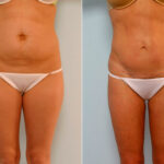 Abdominoplasty before and after photos in Houston, TX, Patient 24219