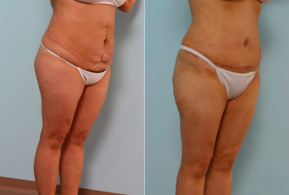 Abdominoplasty before and after photos in Houston, TX, Patient 24401