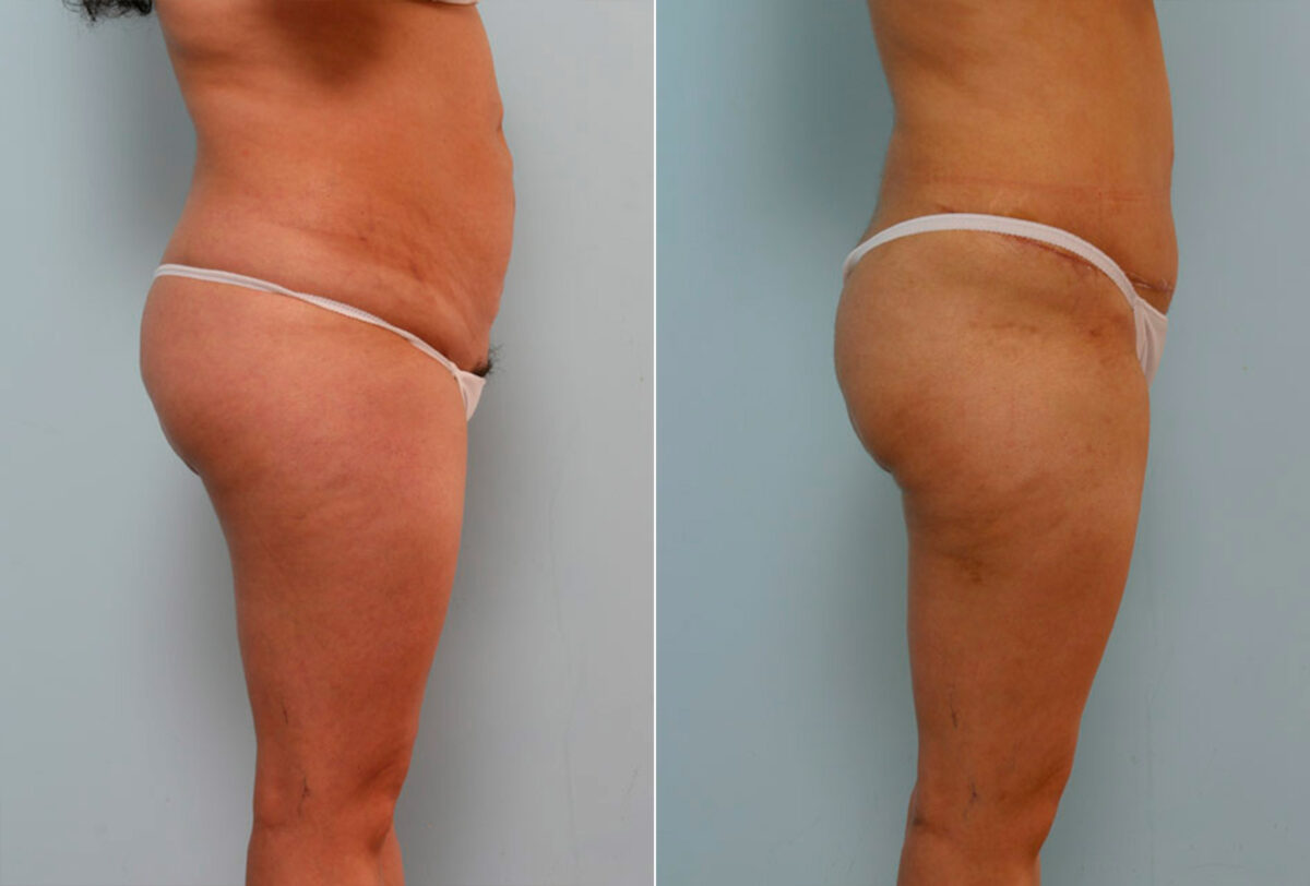 Abdominoplasty before and after photos in Houston, TX, Patient 24401