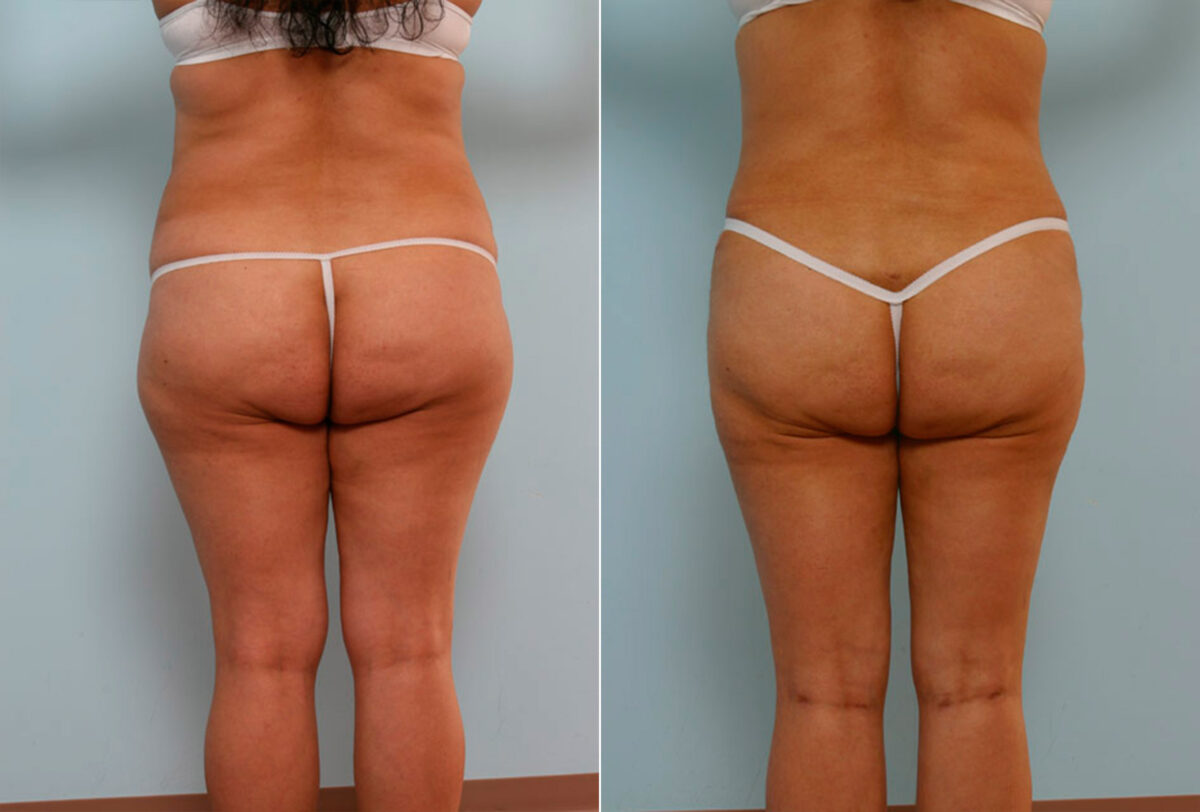 Abdominoplasty before and after photos in Houston, TX, Patient 24401