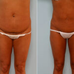 Abdominoplasty before and after photos in Houston, TX, Patient 24410