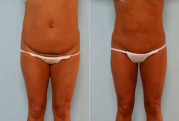 Abdominoplasty before and after photos in Houston, TX, Patient 24410