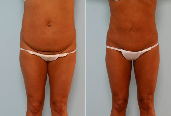 Tummy Tuck/Abdominoplasty before and after photos in Houston, TX, Patient 24410