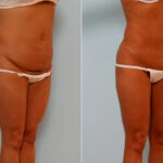 Abdominoplasty before and after photos in Houston, TX, Patient 24410