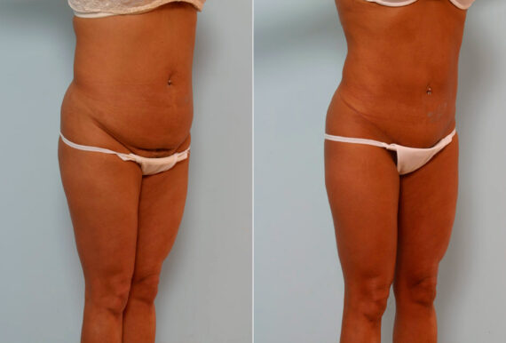 Abdominoplasty before and after photos in Houston, TX, Patient 24410