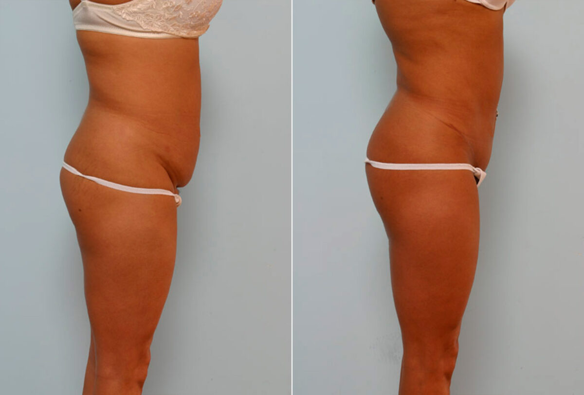 Abdominoplasty before and after photos in Houston, TX, Patient 24410