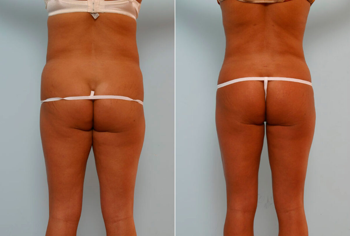 Abdominoplasty before and after photos in Houston, TX, Patient 24410