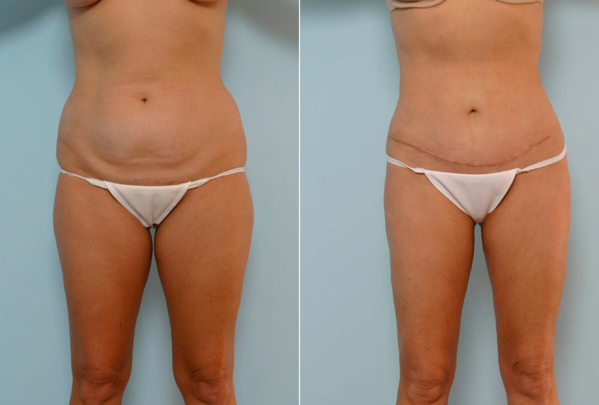 Tummy Tuck/Abdominoplasty before and after photos in Houston, TX, Patient 24419