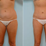 Abdominoplasty before and after photos in Houston, TX, Patient 24419