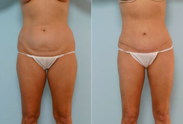 Abdominoplasty before and after photos in Houston, TX, Patient 24419