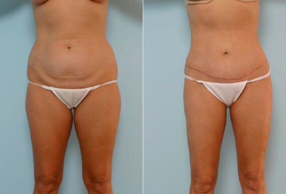 Tummy Tuck/Abdominoplasty before and after photos in Houston, TX, Patient 24419