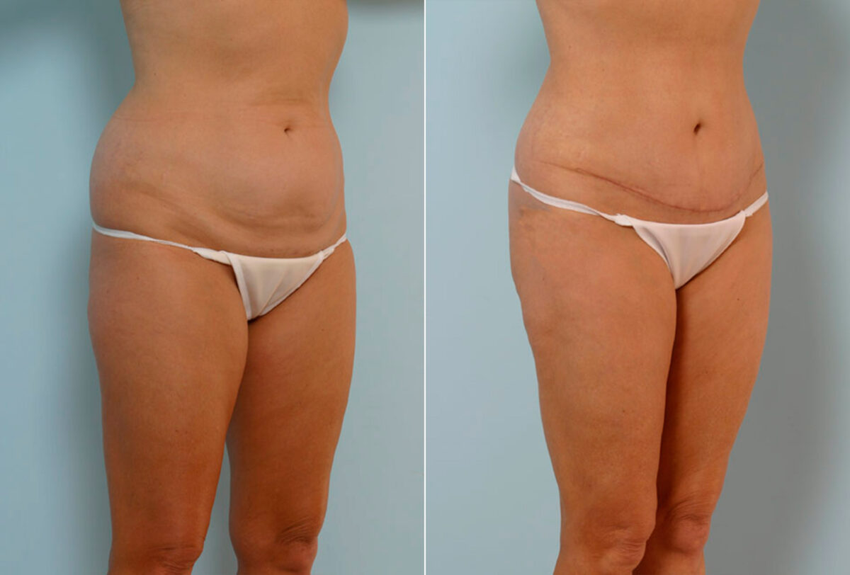 Abdominoplasty before and after photos in Houston, TX, Patient 24419