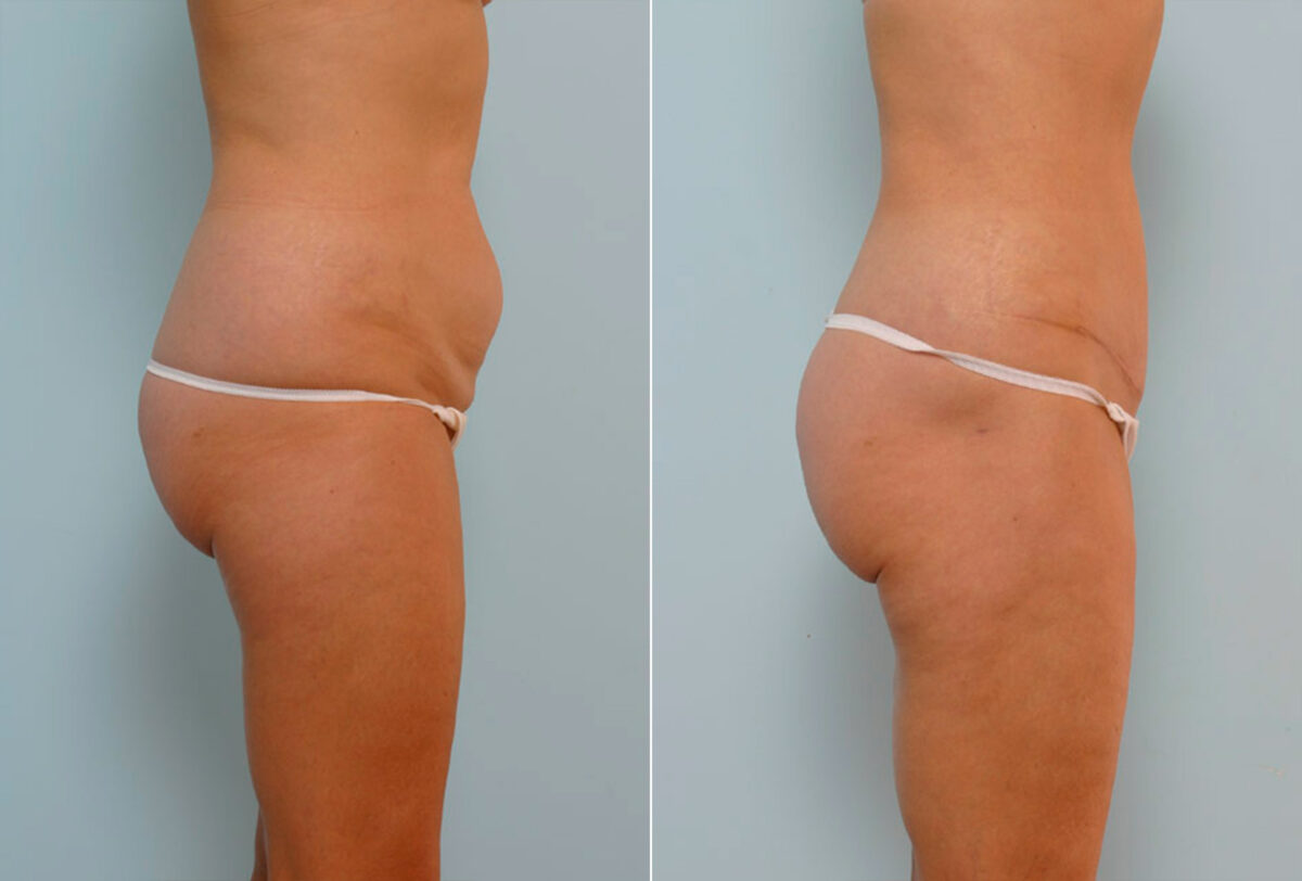 Abdominoplasty before and after photos in Houston, TX, Patient 24419