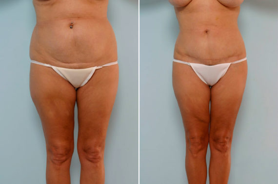 Abdominoplasty Before and After Photos in Houston, TX, Patient 24588