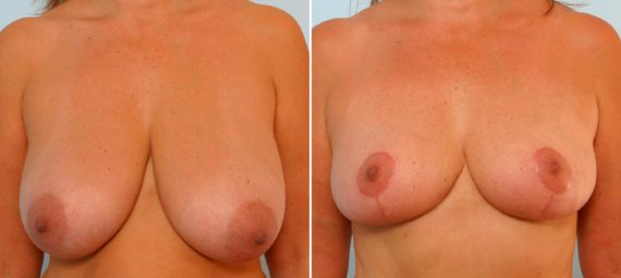 Breast Reduction Before and After Photos in Houston, TX, Patient 27587