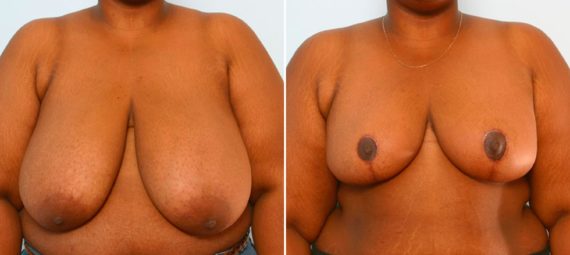 Breast Reduction Before and After Photos in Houston, TX, Patient 27538