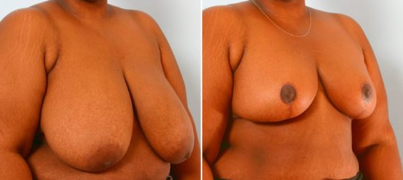 Breast Reduction Before and After Photos in Houston, TX, Patient 27538