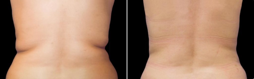 Getting Rid of Bra Bulge with Liposuction