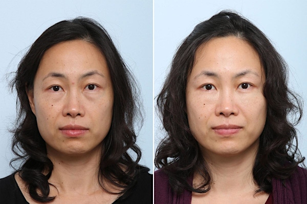 juvederm-voluma-xc-ba-dr-vitenas-houston