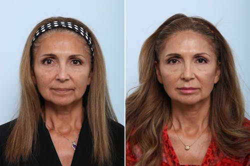 lip-augmentation-ba-dr-vitenas-houston-1