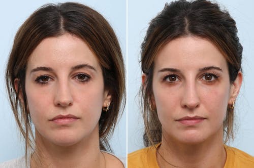 non-surgical-rhinoplasty-before-after-dr-vitenas-houston-1