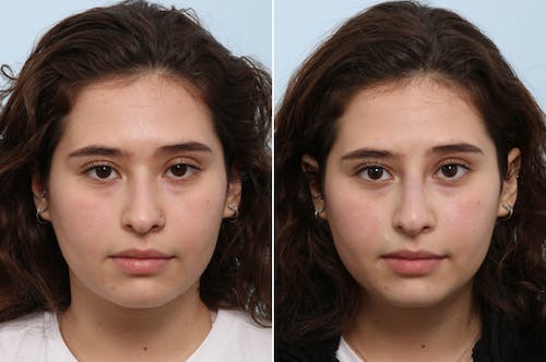 non-surgical-rhinoplasty-before-after-dr-vitenas-houston-3