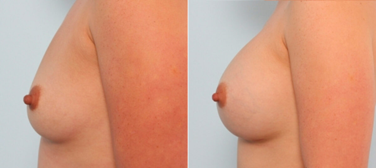 Breast Augmentation before and after photos in Houston, TX, Patient 24666