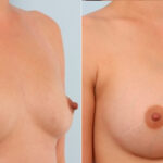 Breast Augmentation before and after photos in Houston, TX, Patient 24666