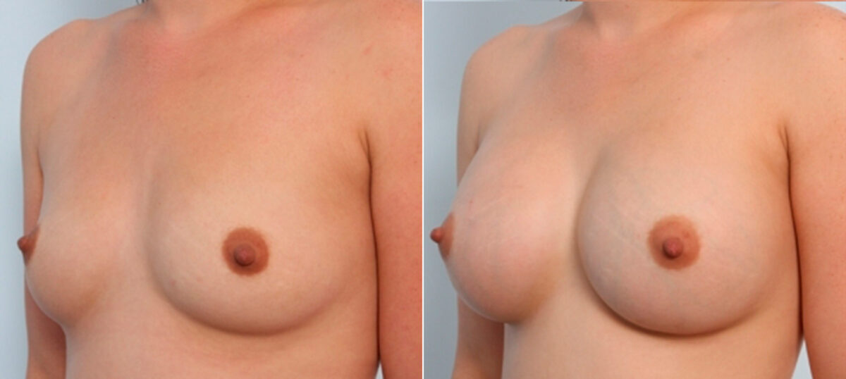 Breast Augmentation before and after photos in Houston, TX, Patient 24666