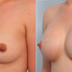 Breast Augmentation before and after photos in Houston, TX, Patient 24666